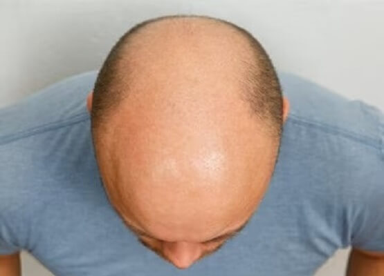 best-hair-loss-treatment-male-after_594393-162-نسخة (1)