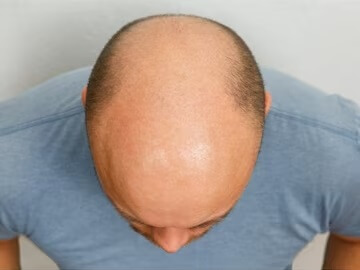 __best-hair-loss-treatment-male-after_594393-162 - نسخة