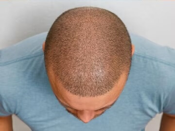 best-hair-loss-treatment-male-after_594393-162