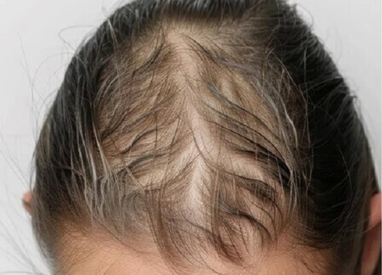 ____hair-loss-growth-woman-comparison-treatment-haircare-texture-care-salon_590464-301774 - نسخة - نسخة