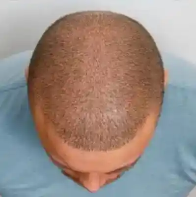 best-hair-loss-treatment-mal-1