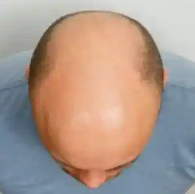 best-hair-loss-treatment-male-after_594393-162-نسخة-1